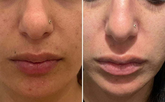 Soins Sweet Nabbody, avant et après, photo d'une cliente