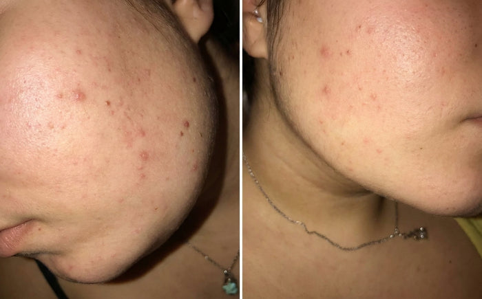 Masque Nila Royal, avant et après, photo d'une cliente