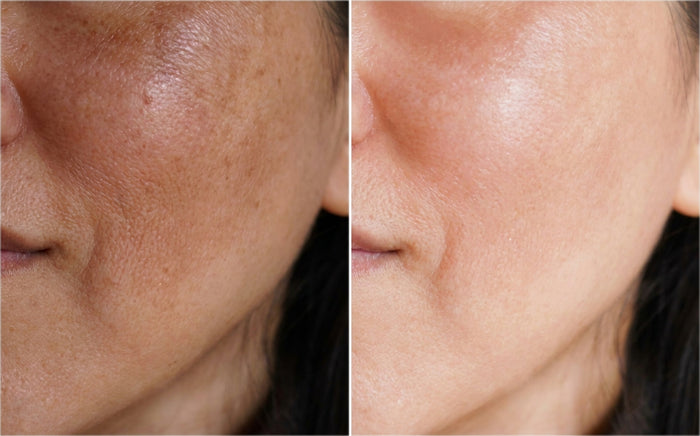 Masque Nila Royal, avant et après, photo d'une cliente