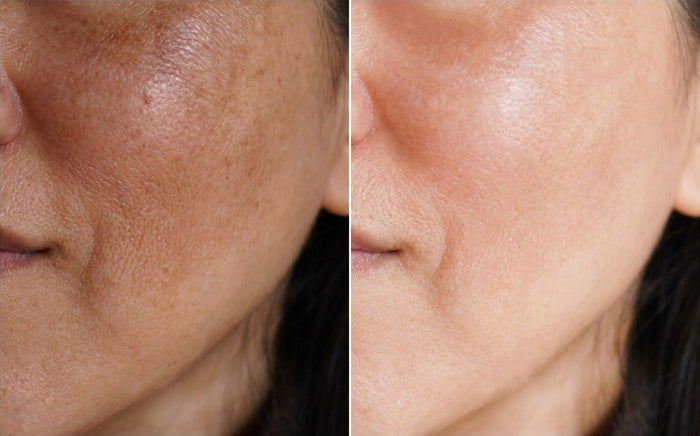 Masque Nila Royal, avant et après, photo d'une cliente