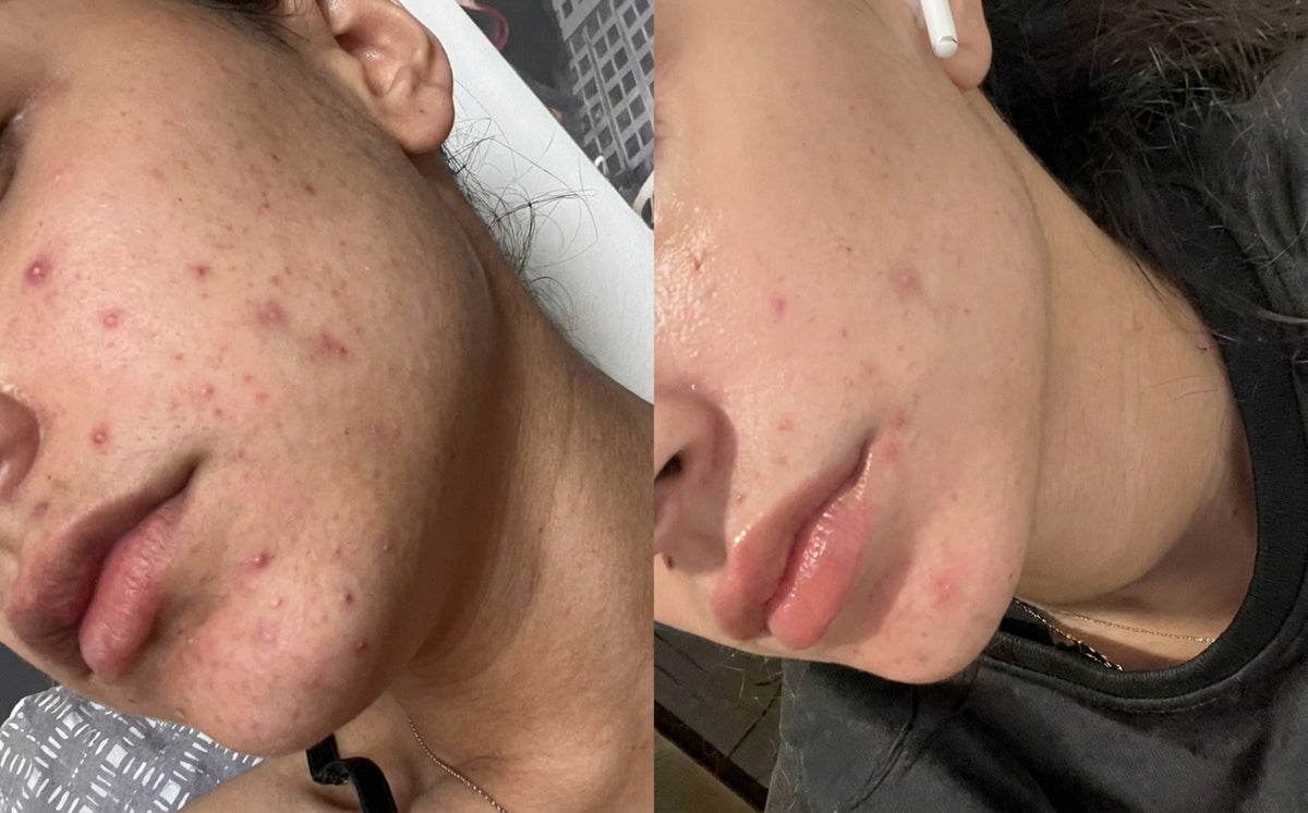 Masque Nila Royal, avant et après, photo d'une cliente, Sweet Nabbody